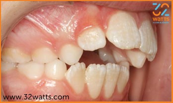 Do you Have Gaps in Your Teeth?