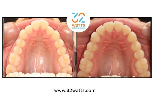 spacing clear aligner before and after