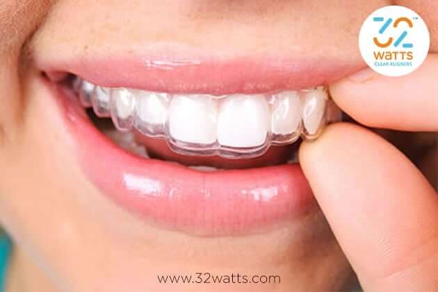 Type of Braces Work the Fastest