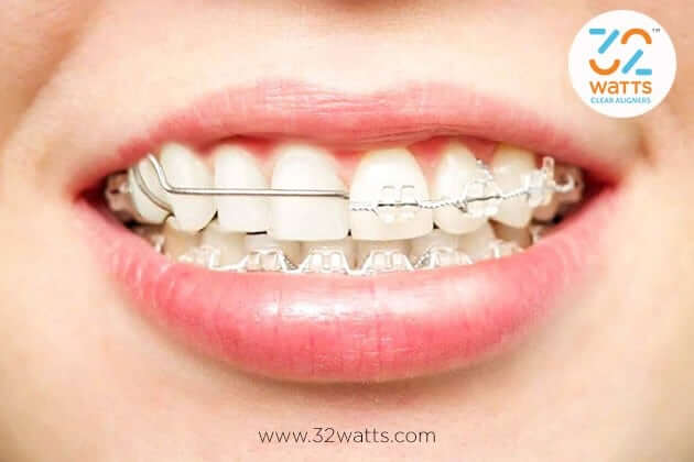 What Type of Braces Work The Fastest