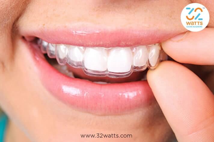 Best Clear Aligners Provider in India