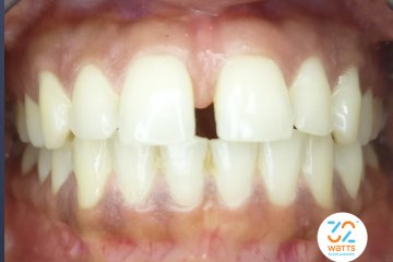 How to Reduce the Gap between Teeth